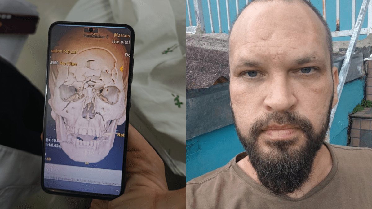 Motociclista se recupera após ter crânio “triturado” em acidente no PR